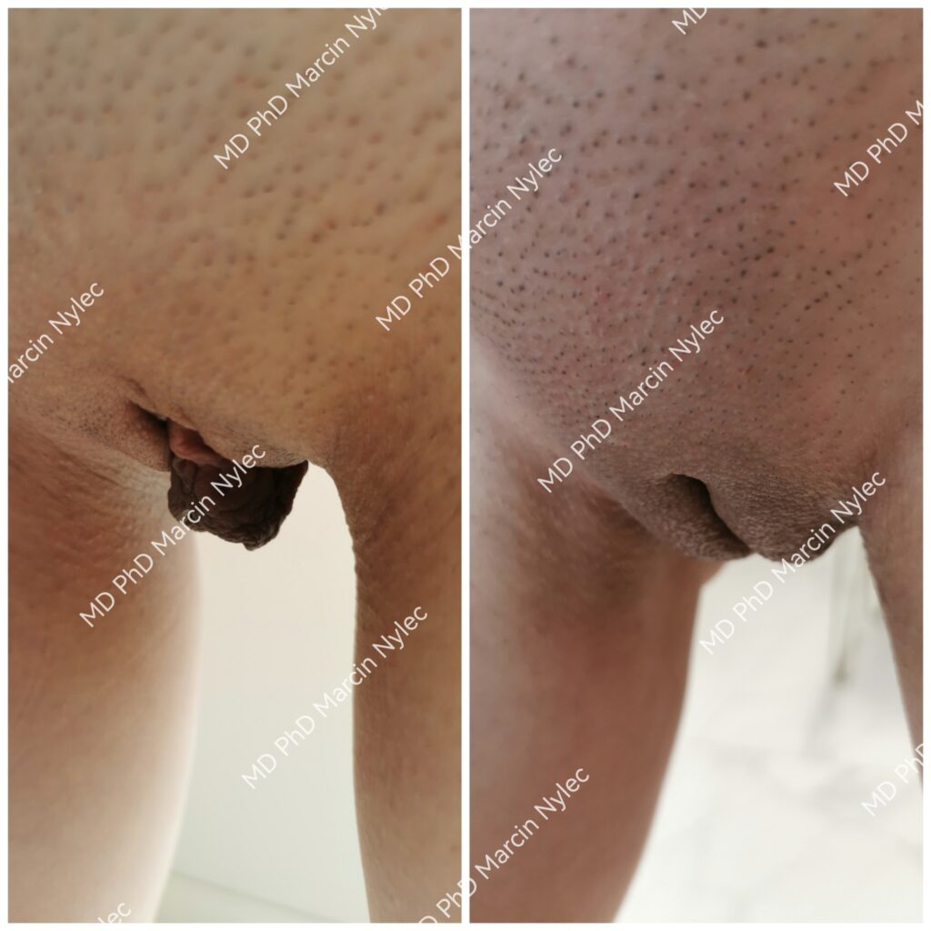 Labioplastyka Wielkopolskie, przed i po zabiegu zdjecie 37