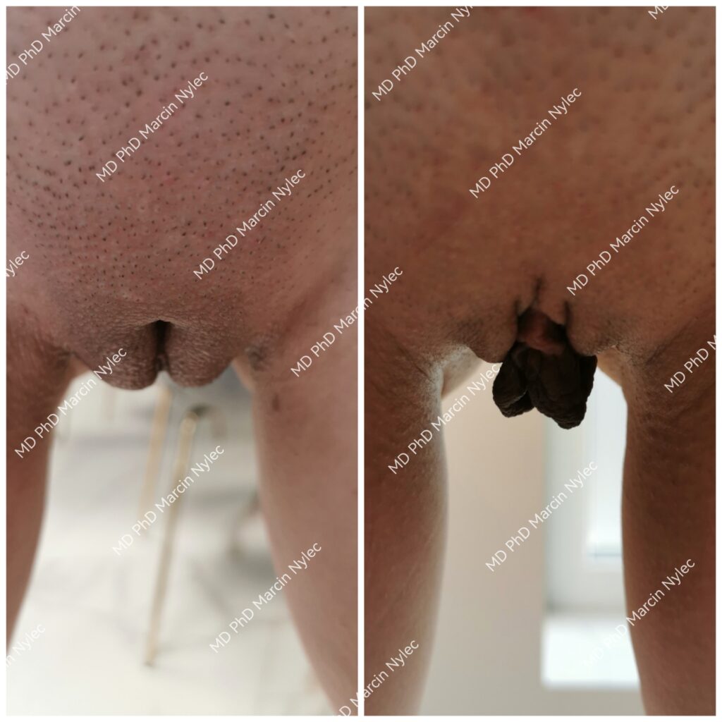 Labioplastyka Wielkopolskie, przed i po zabiegu zdjecie 39