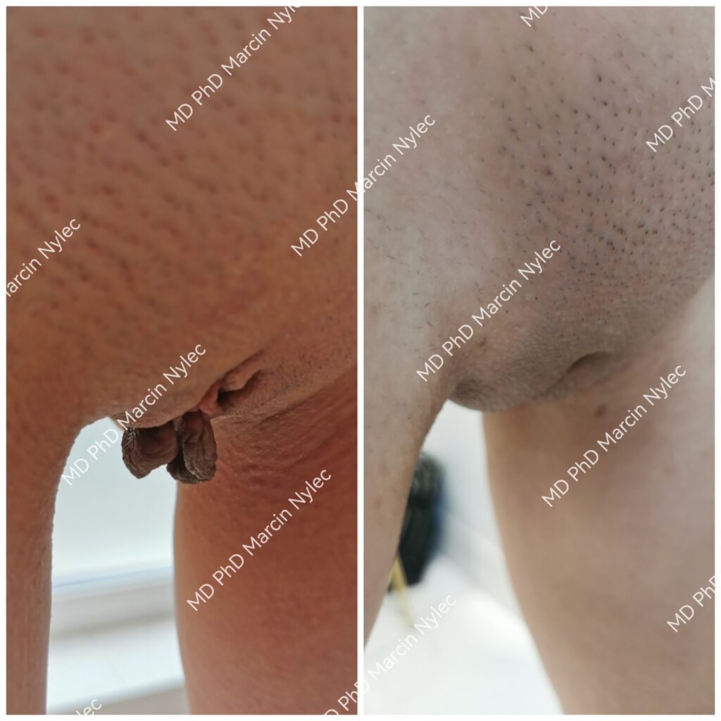 Labioplastyka Wielkopolskie, przed i po zdjecie 35