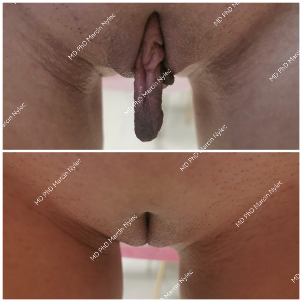 Labioplastyka Poznań efekty dr nylec pacjent 48