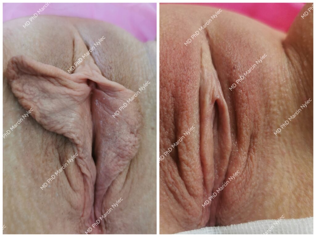 Labioplastyka - zdjęcia przed i po zabiegu demonstrujące perfekcyjne rezultaty