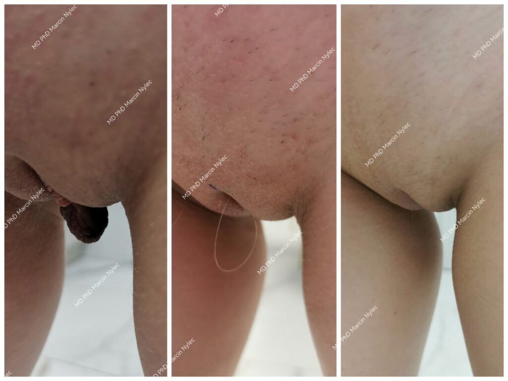 Labioplastyka Przed & Po Pacjent #642 zdjęcie #111