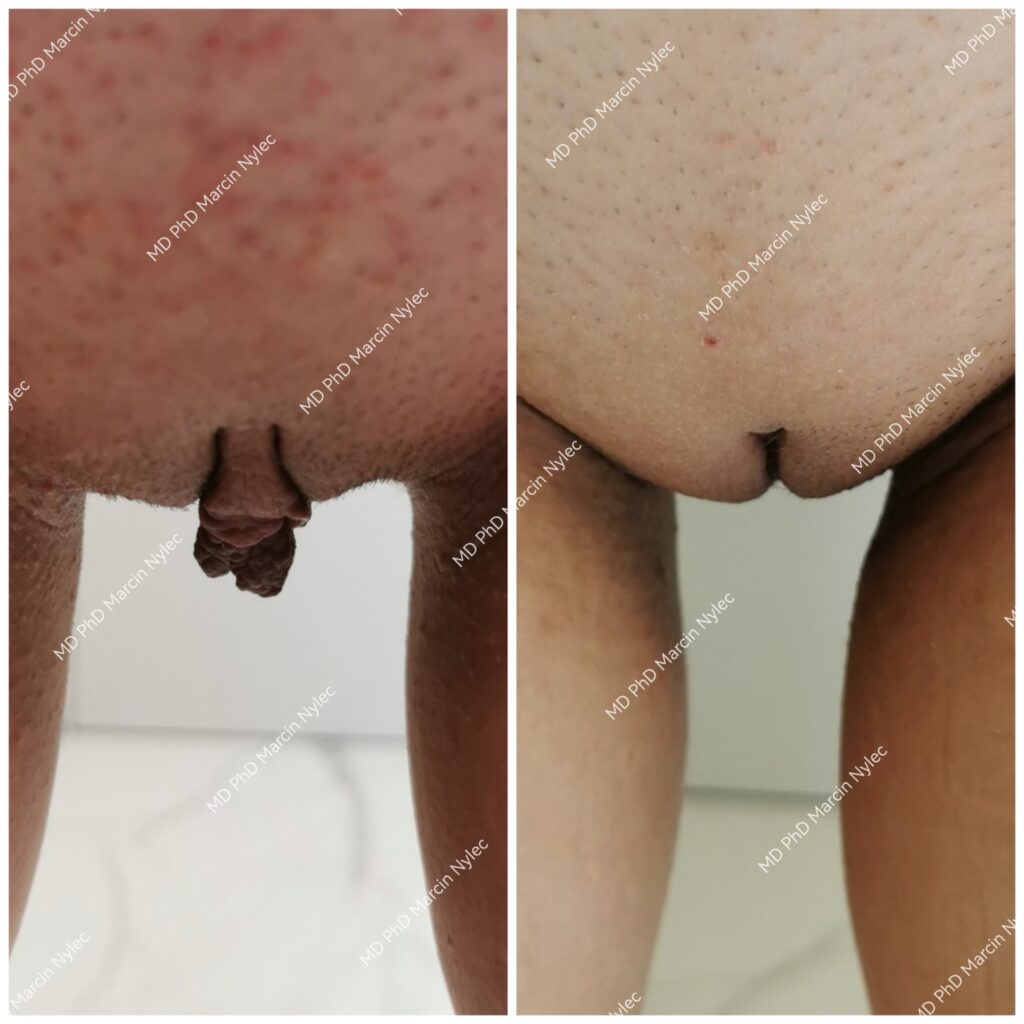 Labioplastyka - zmniejszenie i poprawa wyglądu warg sromowych mniejszych, przed i po operacji.